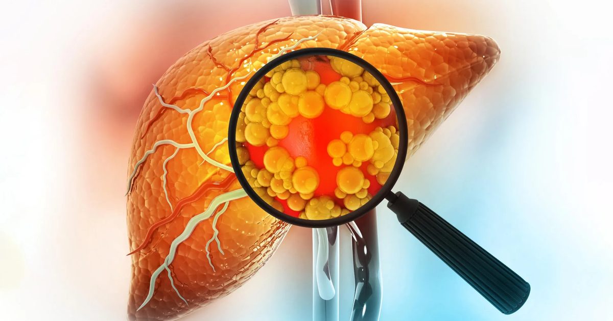 Araştırma: Şeker İkamesi Sorbitol Karaciğeri Nasıl Etkiliyor?
